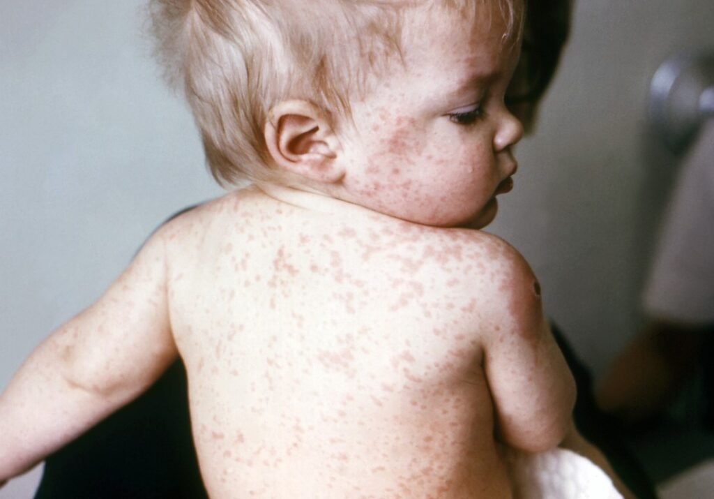 Measles Outbreak in UK: Health Officials Urge Parents to Vaccinate Their Children